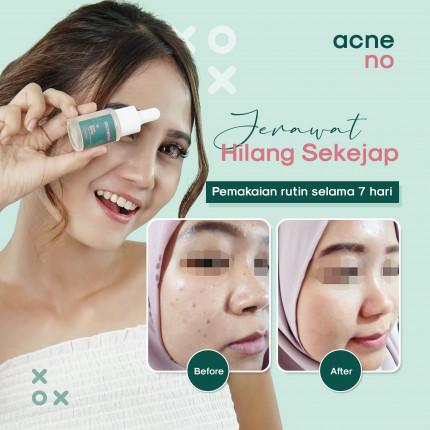 Produk Acneno (M.WP)