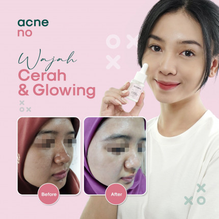 Produk Acneno (M.WP)