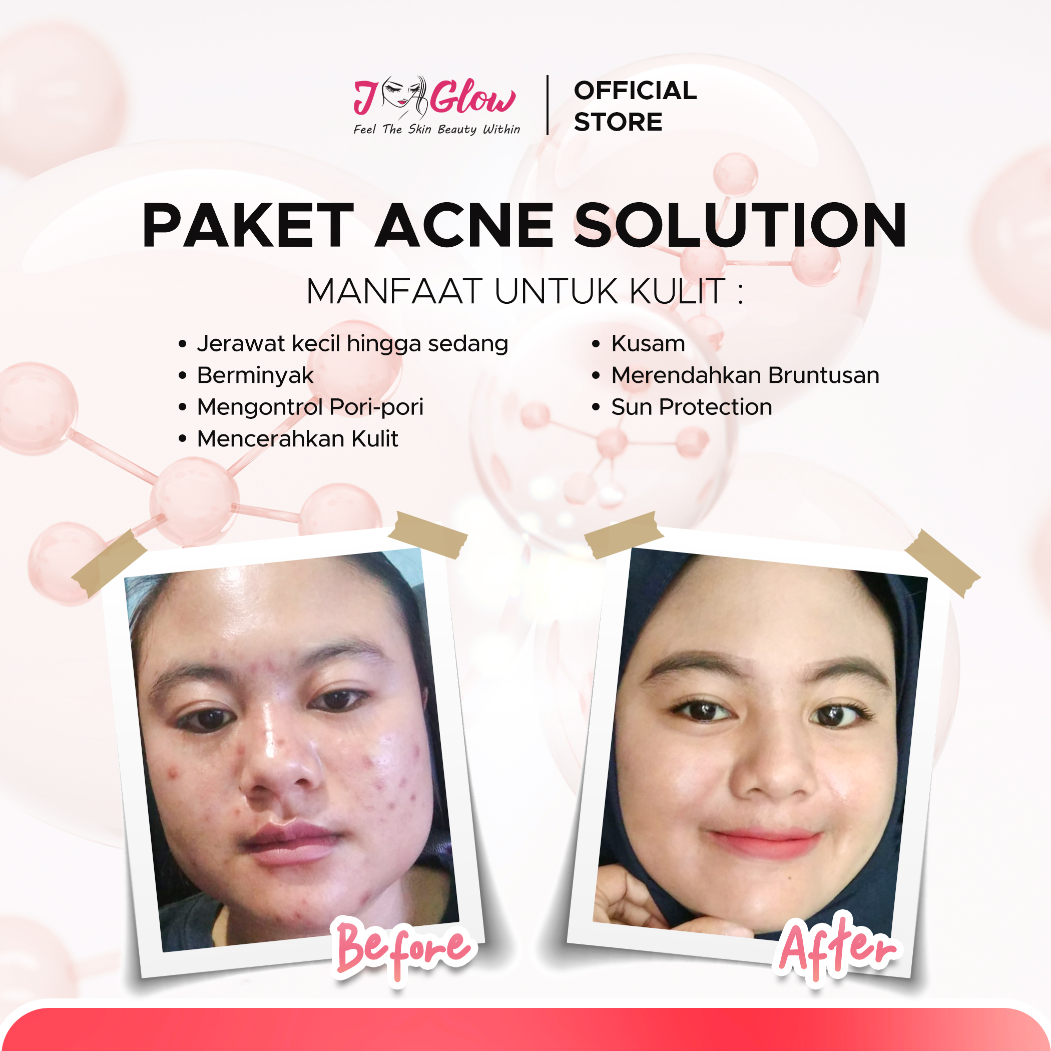 Paket Acne Solution