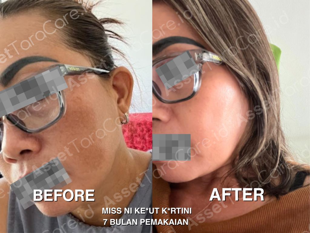 MFO - Taracare Melastop Flek (kill) x