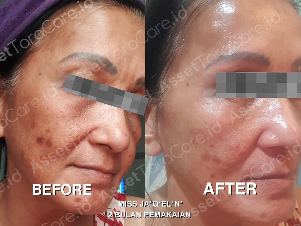 MFO - Taracare Melastop Flek (kill) x