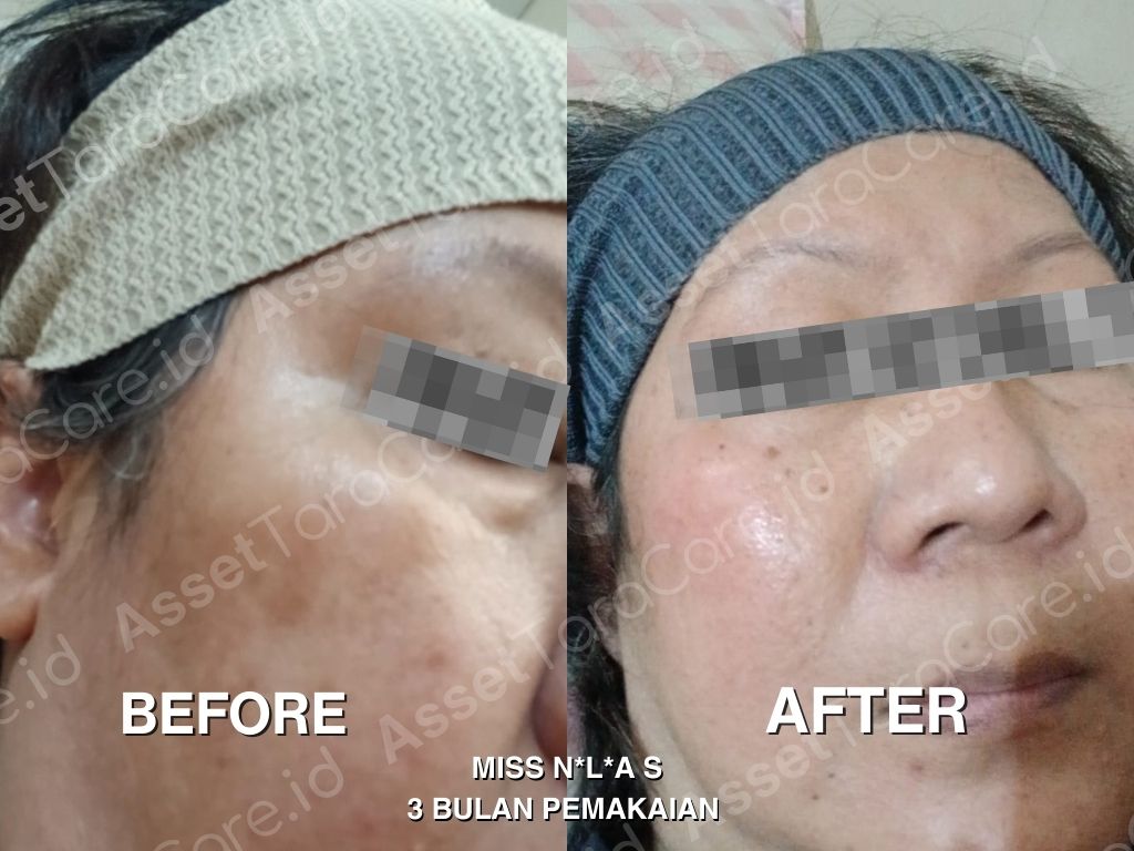 MFO - Taracare Melastop Flek (kill) x