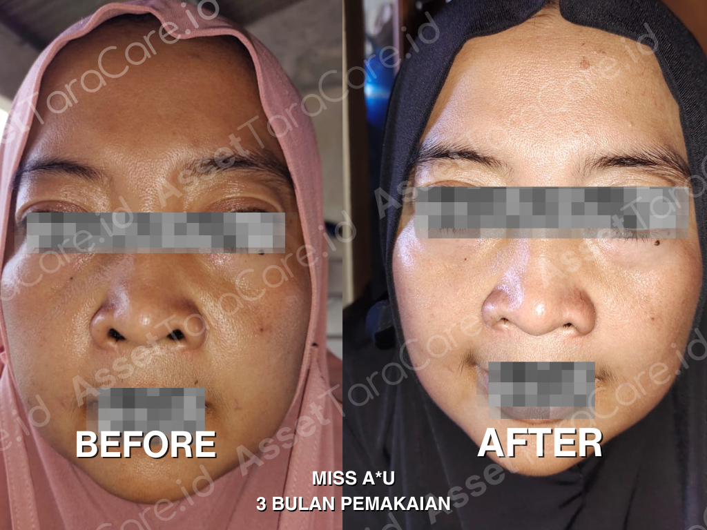 MFO - Taracare Melastop Flek (kill) x