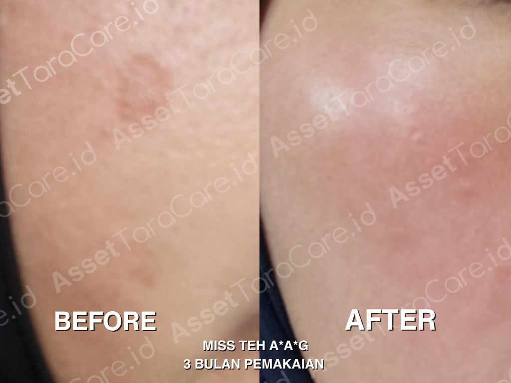 MFO - Taracare Melastop Flek (kill) x