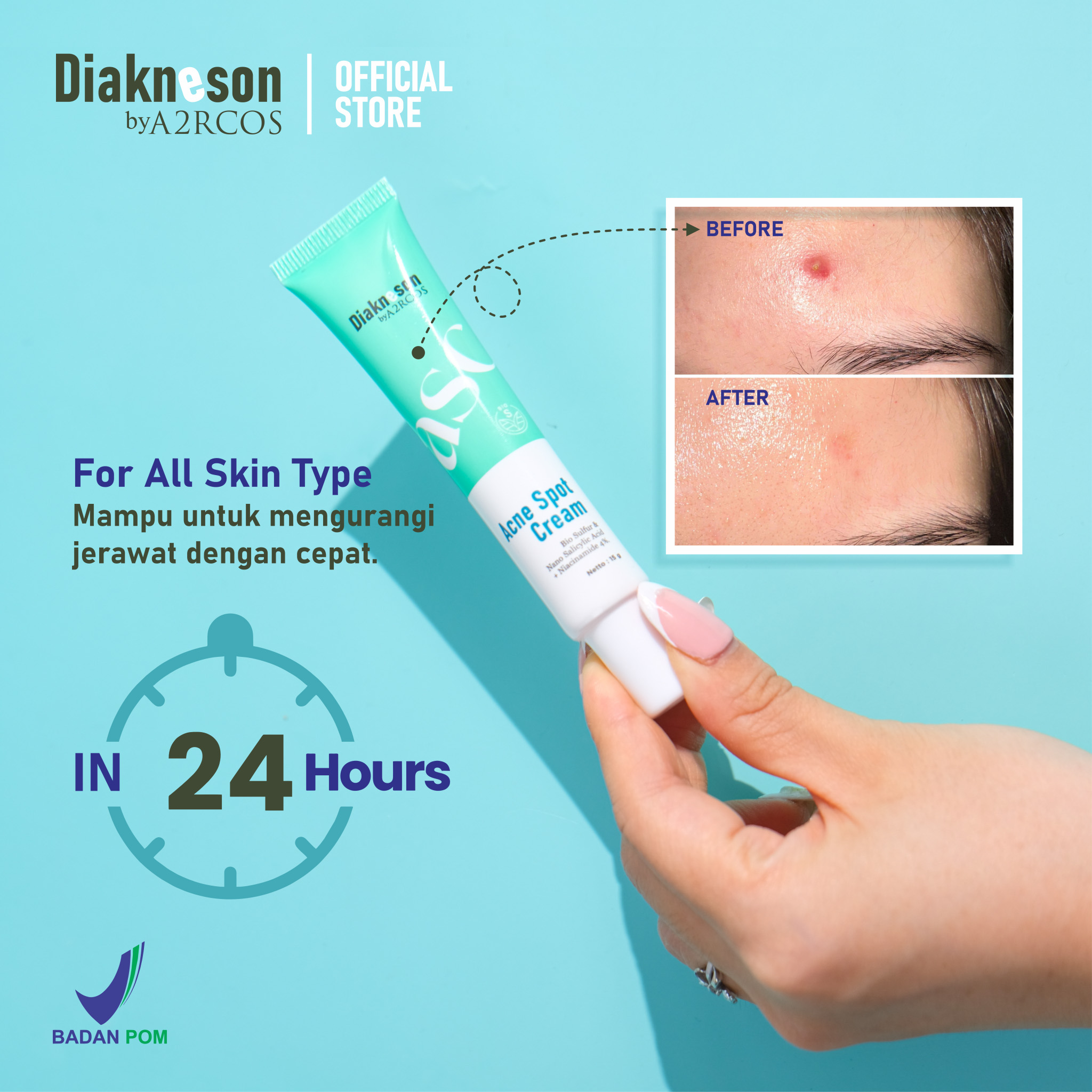 Acne Spot Cream