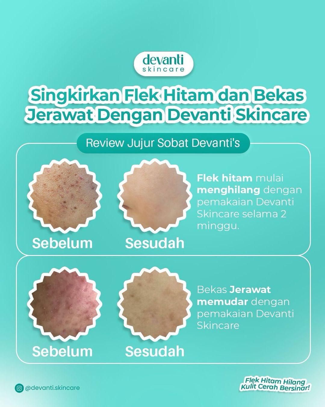 Devanti Promo Hemat | Penghilang Ampuh Flek Hitam Jerawat & Bekasnya (Paket Isi 5 Pcs) + Bonus Pouch