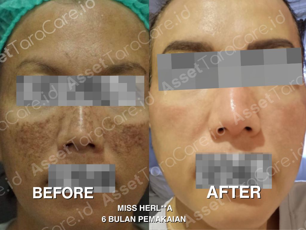 MWO - Taracare Whitening Skincare